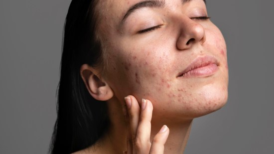 PORTADA ACNE