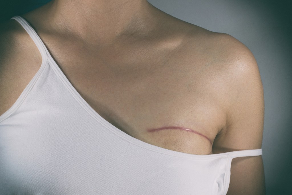 Cicatriz por cirugía de cáncer de mama - iStock