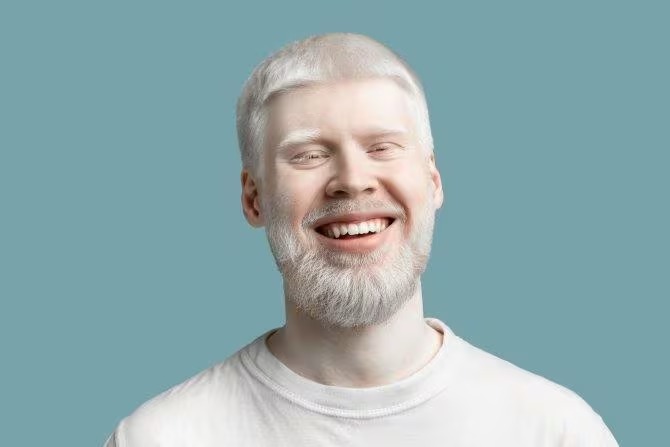 Persona albina. Fuente: iStock Prostock-Studio