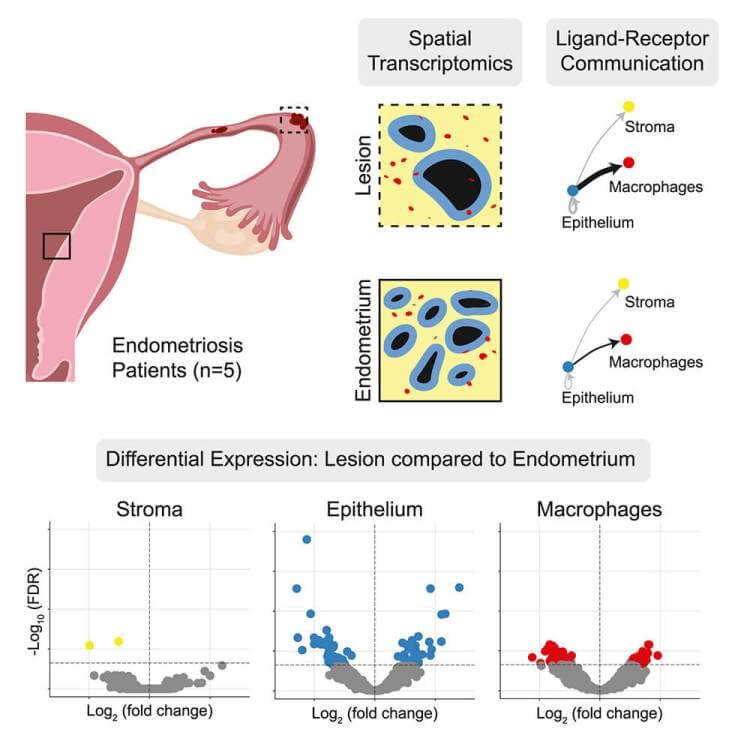El descubrimiento que podría transformar el tratamiento de la endometriosis sin recurrir a hormonas