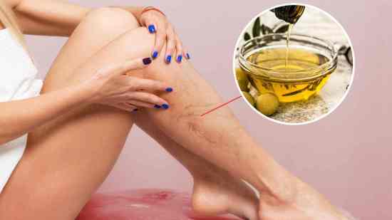 Piernas con varices durante masaje con aceite esencial de ciprés que mejora la circulación y reduce la inflamación