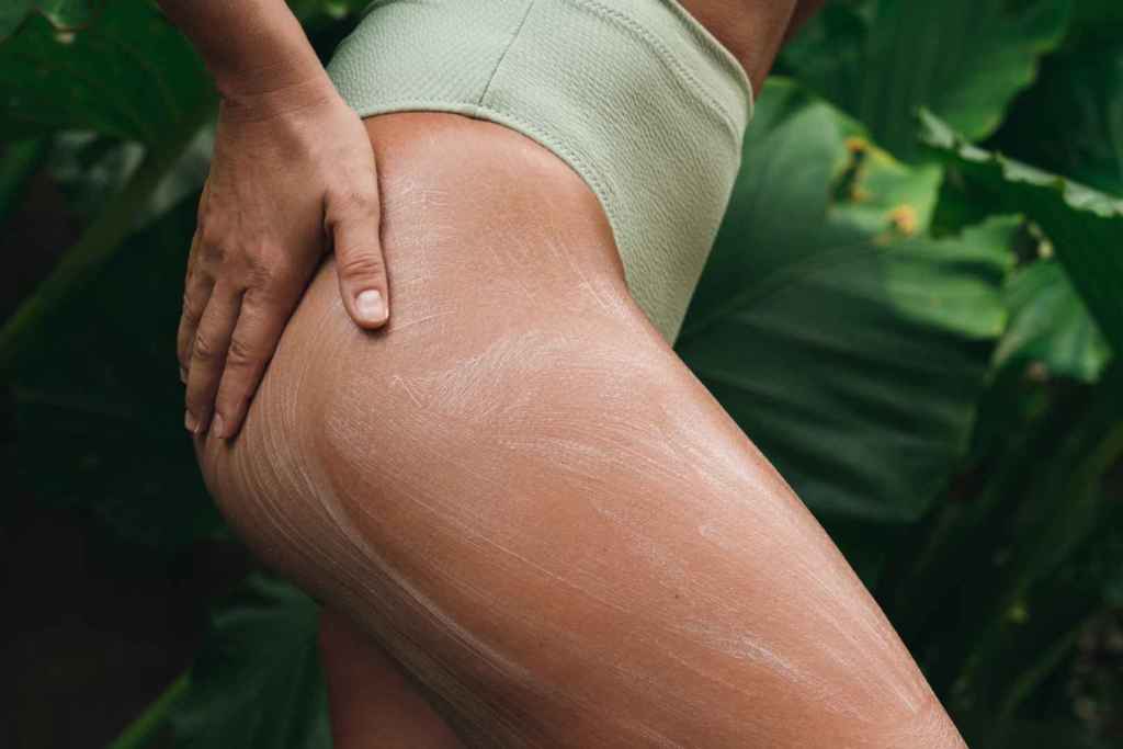 Las estrías no deben exponerse al sol sin protección